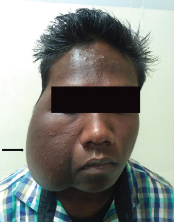 Pre-treatment image showing right-sided face and parotid region painless and progressively increasing swelling (arrow).